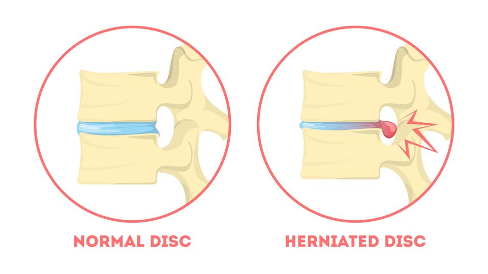 Symptoms of a Herniated Disc?