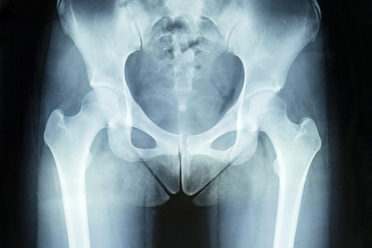 Diagnosing Hip Pain After an Auto Accident 