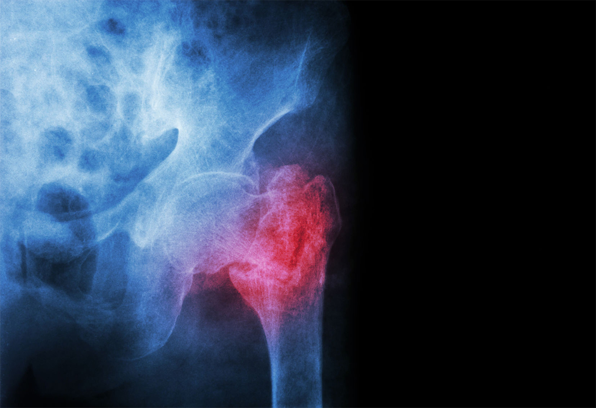 Types of Hip Pain After a Work Injury