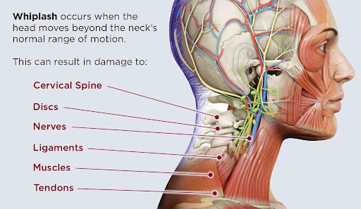 Auto Accidents and Pinched Nerves: Can a Chiropractor Help in Portland, Oregon?