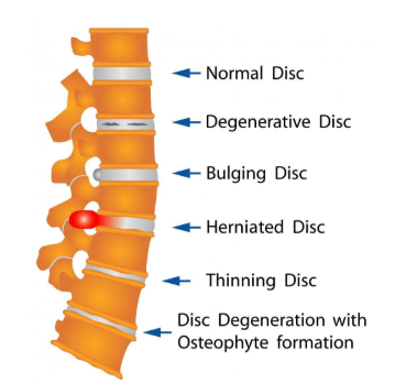 Whiplash Injuries From Auto Accidents