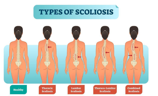 Scoliosis Chiropractor in Portland