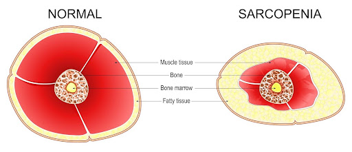 Sarcopenia